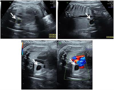 Case Report: Prenatal and Postnatal Management for Fetal Bronchogenic Cysts During the COVID-19 Pandemic